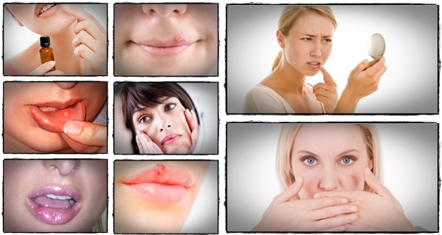 genital-herpes-treatment-herpes-wise-teaches-people-how-to-get-rid